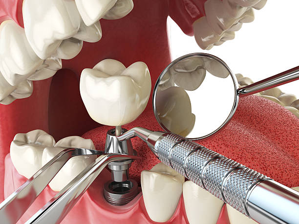 Best Broken or Cracked Tooth Emergency Dentist in Rigby, ID
